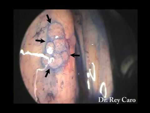 szarvasmarha-papillomatosis differenciáldiagnosztika