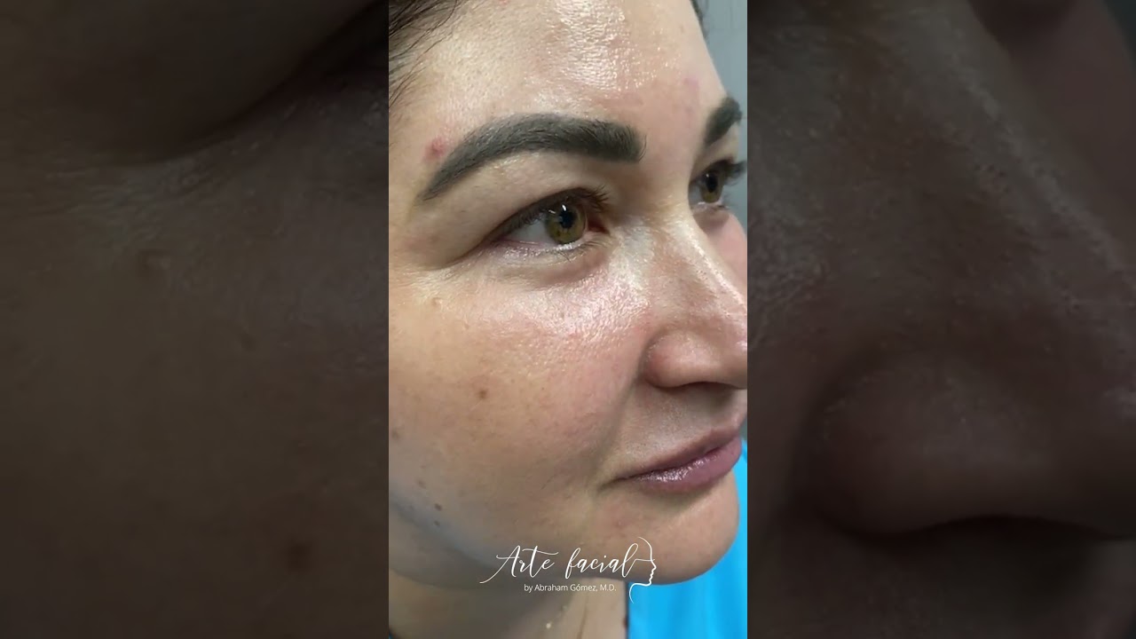 Blefaroplastia de párpados superiores e inferiores
