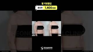 팔 지방흡입… 한달만에 이렇게 바뀜? 🫢