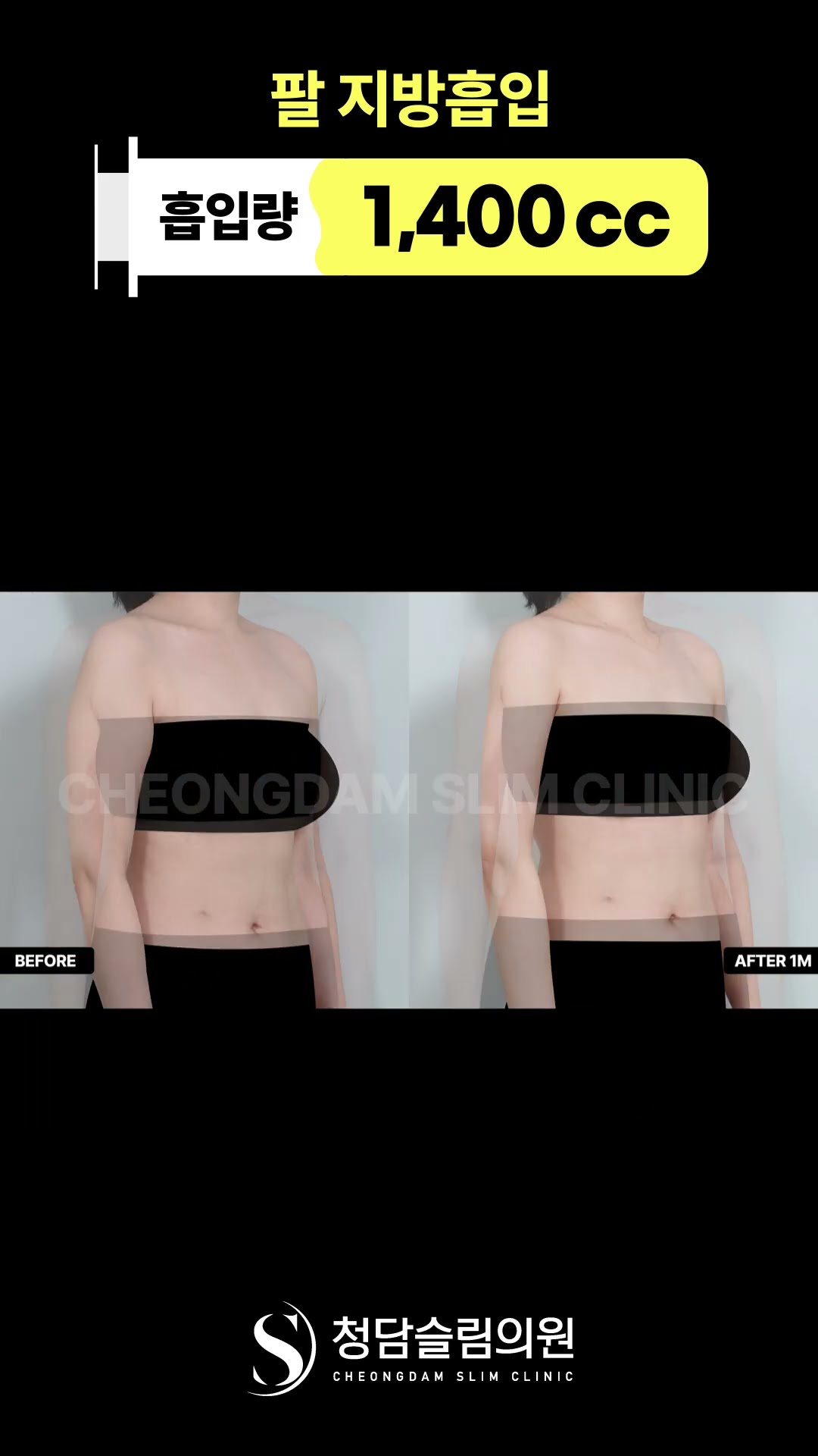 팔 지방흡입… 한달만에 이렇게 바뀜? 🫢