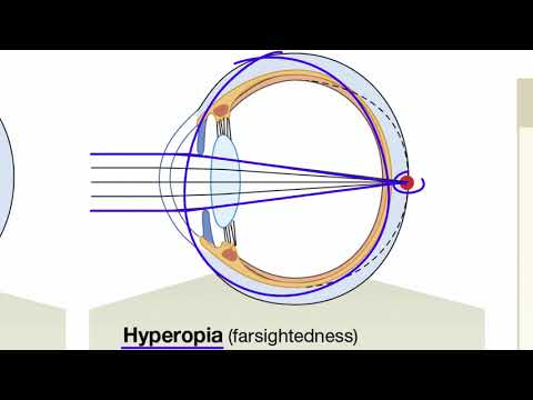 Light Refraction and Focused Vision in the Eye