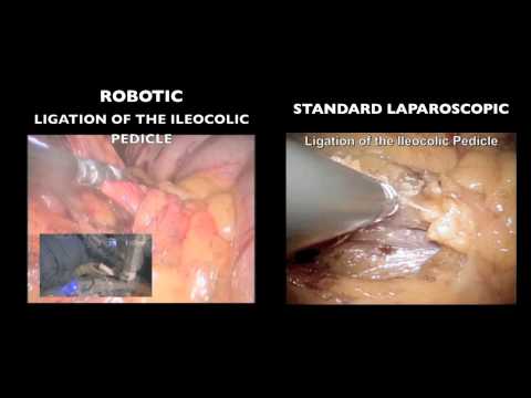 Right Colon Removal Single Incision Surgery: Differences Between Laparoscopic and Robotic Approach