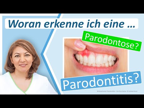 Parodontose: Typische Symptome! Woran erkenne ich eine Parodontitis? Zahnarztpraxis Großostheim