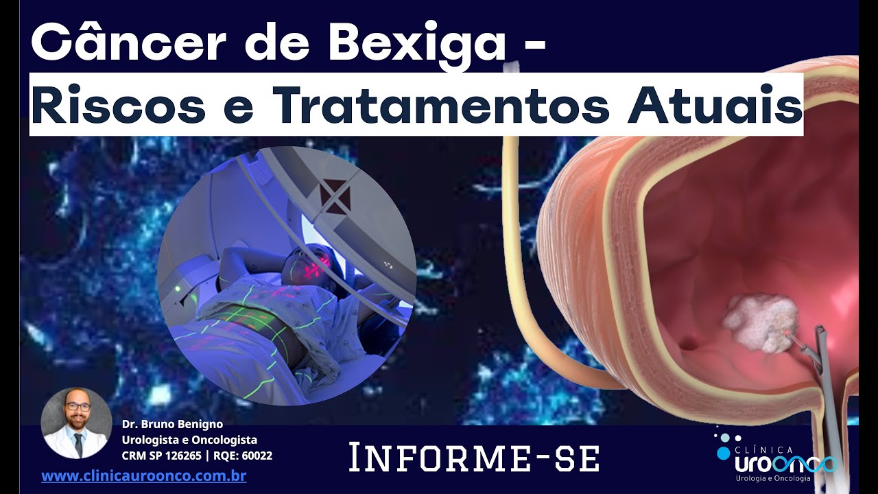 Câncer de Bexiga Superficial aos 30 Anos: Opções de Tratamento e Prognóstico.  Aula para Pacientes