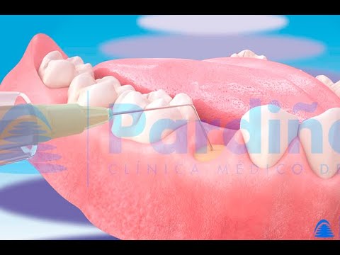 혈소판이 풍부한 플라즈마 ©