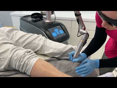 Laserowe usuwanie przebarwień