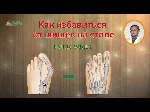 Jak pozbyć się stłuczki na dużych palcach środków ludowej Jak usunąć kość kciuka na ćwiczeniach