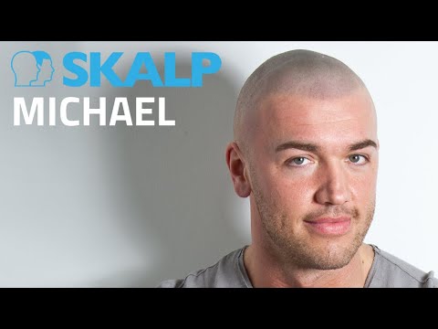 "Take Me Out" star has scalp micropigmentation at Skalp®. Watch Michael’s video.