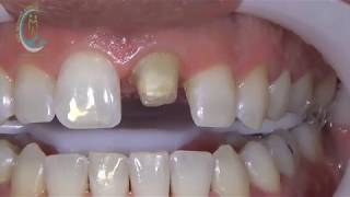 CORONA DE ZIRCONIO Alianza Dental Mx ®