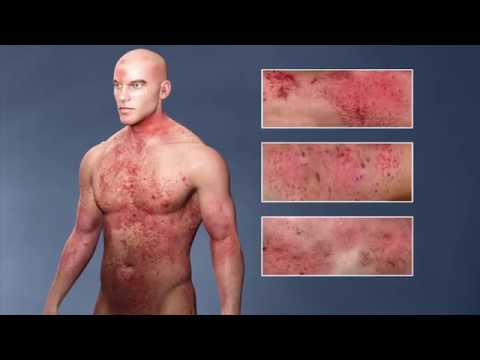 Atopic Dermatitis, (eczema); From the Inside Out