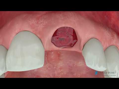 Simultaneous T3® Implants in the Aesthetic Zone