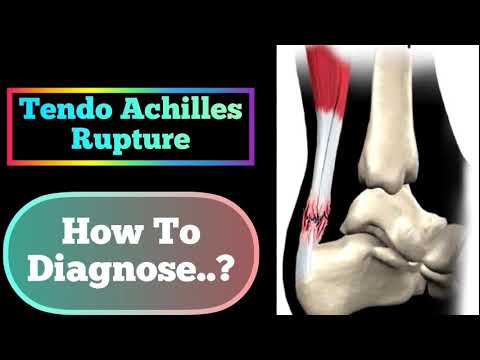 Thompson Test For Achilles Tendon Rupture/Tear | Thompson Test Positive |Achilles Tendon Rupture🔥🔥