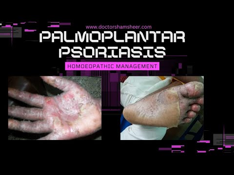 PALMOPLANTAR PUSTULAR PSORIASIS