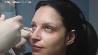 preview picture of video 'Restylane Filler Injection Under the Eye in South Florida'