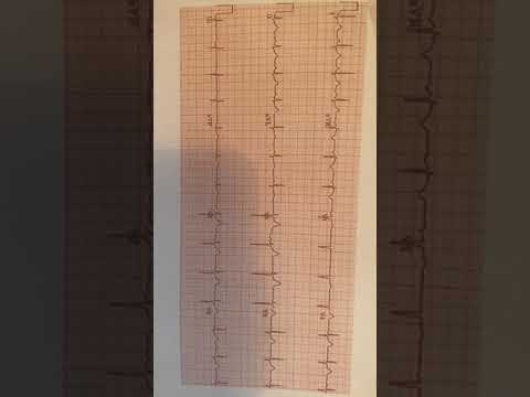 How to Quickly Identify Normal Sinus Rhythm!