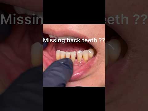 Missing back teeth ? Implants expensive? Dislike  partial dentures?
