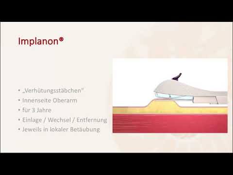 Implanon - Frauenarztpraxis am Potsdamer Platz - Dr. Matthias Stroth & Natalia Egorova