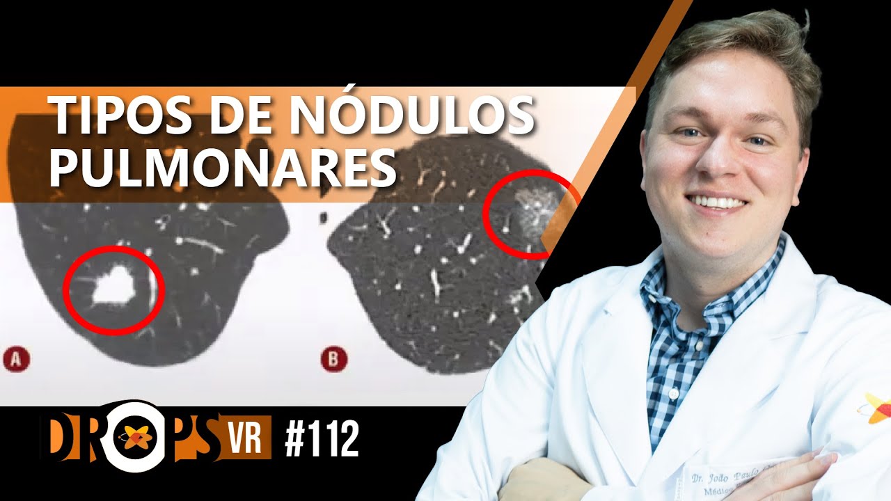 QUAIS SÃO OS TIPOS DE NÓDULOS NA TC DO TÓRAX? I VOCÊ RADIOLOGISTA