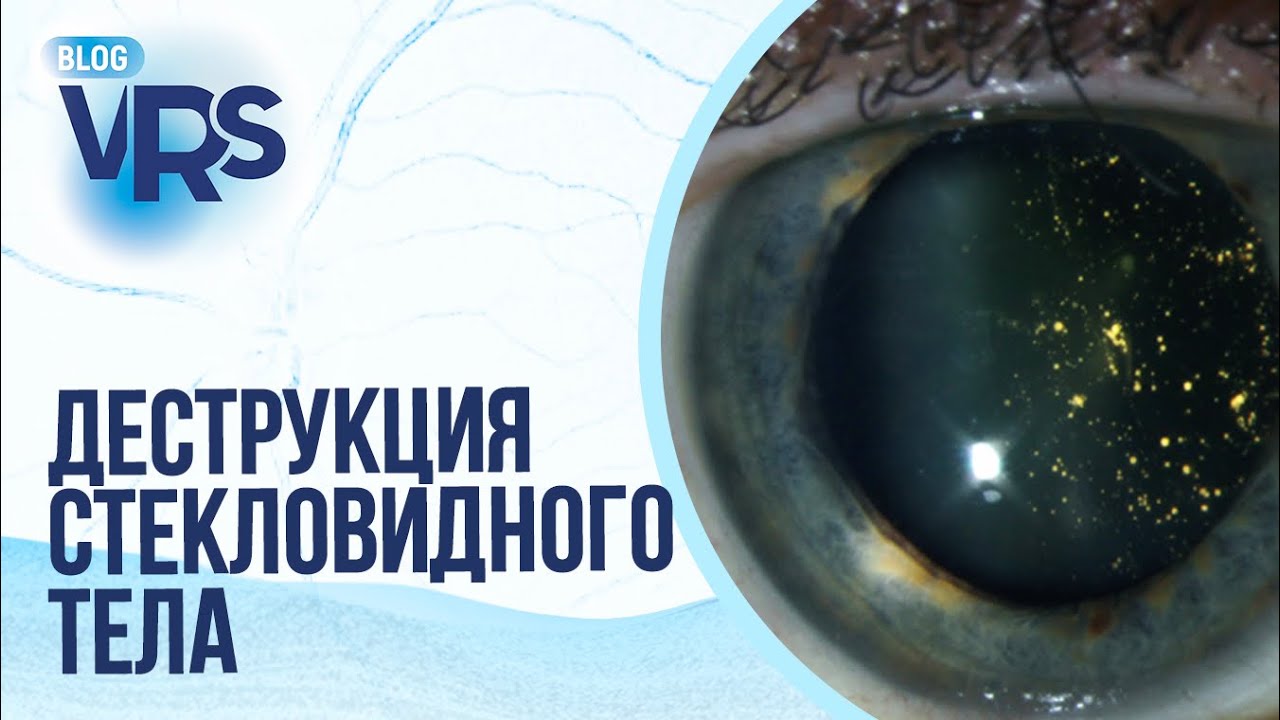 Деструкция стекловидного тела. Нужно ли оперировать Мнение иностранных коллег.