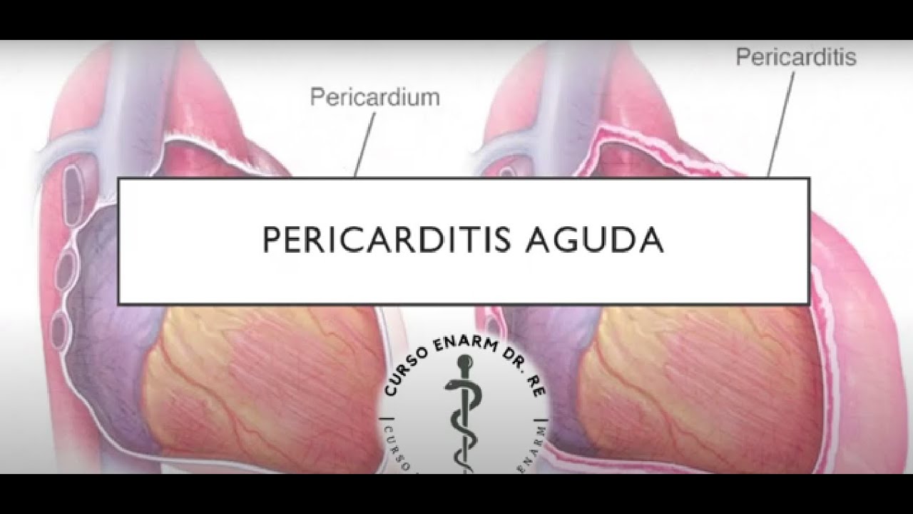 PERICARDITIS AGUDA