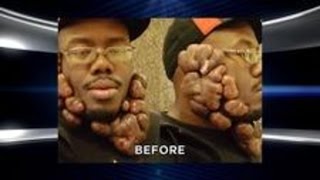 Mind-Blowing Makeovers; Unbelievable Keloid Removal; Extreme Excess Skin Surgery
