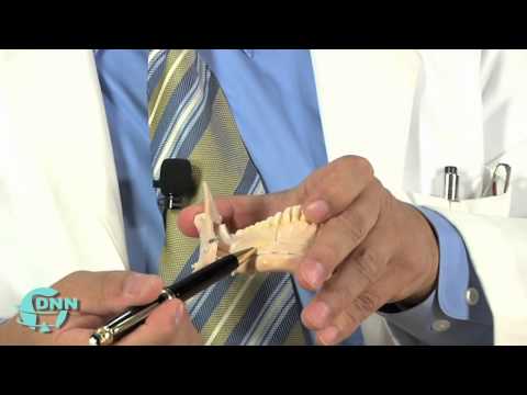 Complications of wisdom tooth extraction Oral Surgeon Dr. Pat Rabot Scottsdale Arizona