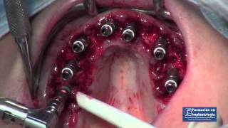 Dr. Ismael Soriano. Implantes postextracción,Plasma rico plaquetas, Electrosoldadura,carga inmediata