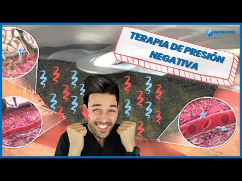 Sistema VAC (presión negativa)