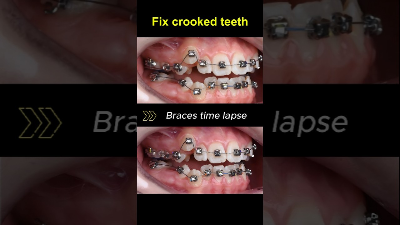 Braces for crooked teeth, transformation before and after #braces #orthodontist #dentist #bracket