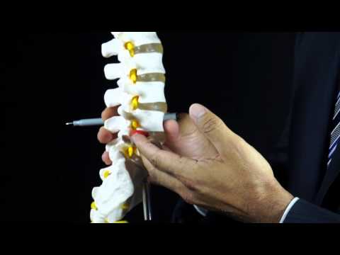 Dr. Nick Nenadovich Explains Herniated Lumbar Discs