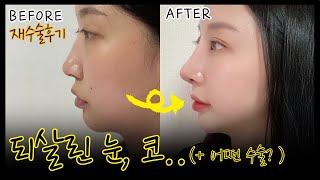 [눈코성형후기] 죽은 코 소생시킨 재수술후기? ?비절개쌍꺼풀, 밑트임, 코재수술?｜서울아이성형외과
