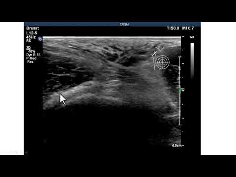 Mama acessória axilar. Achados ultrassonográficos e importância clínica
