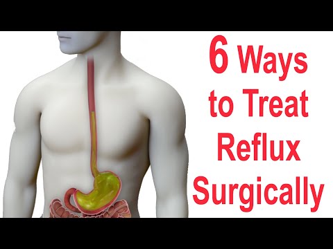 6 Ways to Surgically Treat Reflux (Nissen, Toupet, Dor, LINX, EsophyX, Stretta)