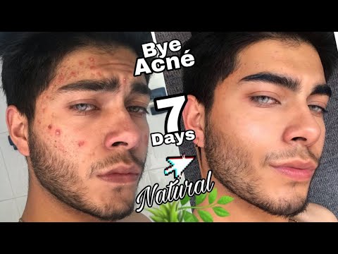 download lagu mp3 mp4 Como Eliminar El Acne Rapido Y Efectivo, download lagu Como Eliminar El Acne Rapido Y Efectivo gratis, unduh video klip Como Eliminar El Acne Rapido Y Efectivo