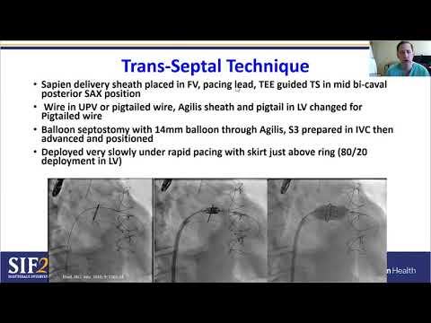 Trans-catheter Mitral Valve in Ring
