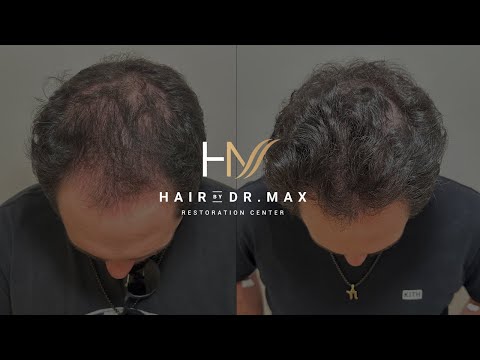 6 months hair transplant post-op. Every graft done by Dr. Max himself—no assistants, no shortcuts.