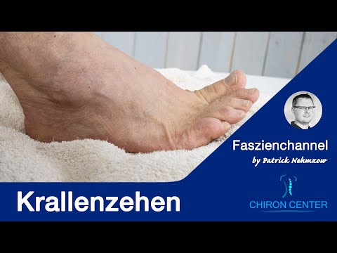 Krallenzehen. Schmerzen im Fuss. Woher kommt das? Was kannst Du tun?