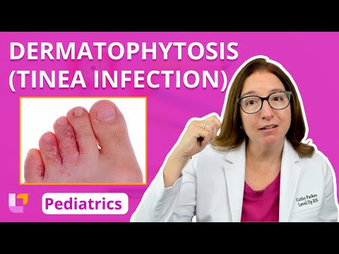 Dermatophytosis (Tinea Infection): Integumentary System - Pediatric Nursing | @LevelUpRN