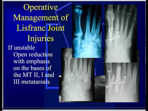 Lisfranc Injury (Tarsometatarsal fracture-dislocation) - Foot ... Lisfranc Injury (Tarsometatarsal fracture-dislocation) - Foot ...