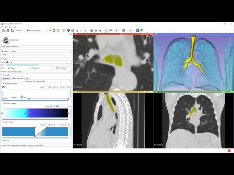 Airway segmentation from CT in 1 minute using 3D Slicer