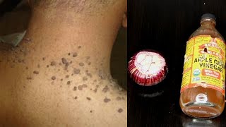 In one night remove skin tag overnight apply for 3 days