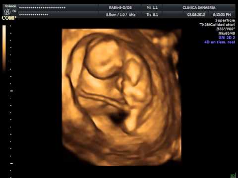ECOGRAFIA 4D 12 SEMANAS DE GESTACION DE CLINICA SANABRIA