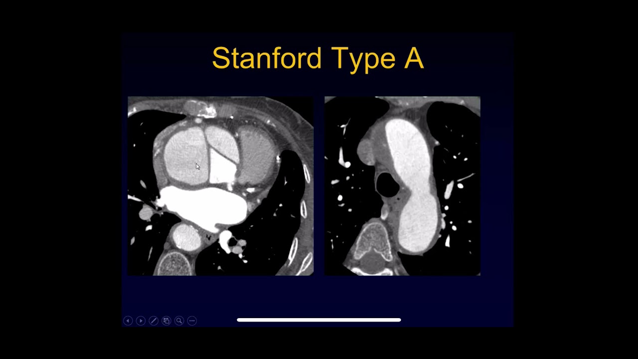 CT evaluation of Aortic dissection and intramural hematoma