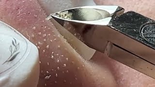 Download Lagu relax,Satisfying,nose blackheads,tweezers,acne treatment,鼻角栓,ピンセット,피지제거 040 Thumbnail