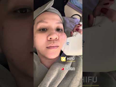 只需RM280医美项目来打救我的【痘印和毛孔粗大】！