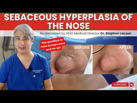 DERMATOLOGIST EXPLAINS: HOW TO TREAT NOSE BUMPS DUE TO SEBACEOUS HYPERPLASIA