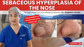 DERMATOLOGIST EXPLAINS: HOW TO TREAT NOSE BUMPS DUE TO SEBACEOUS HYPERPLASIA