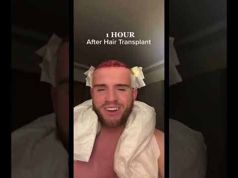 Hair Transplant Results !