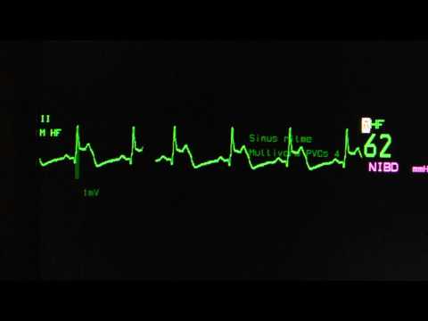 ST elevation on the monitor lead on an ECG monitor