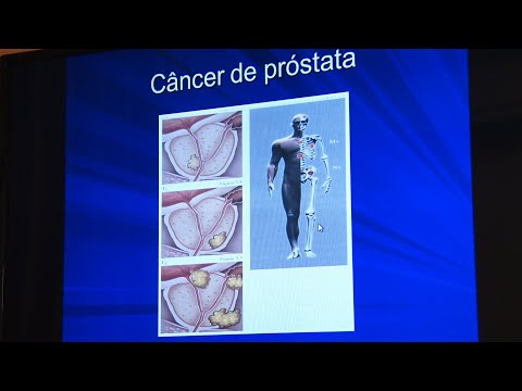 operador de cáncer de próstata albano